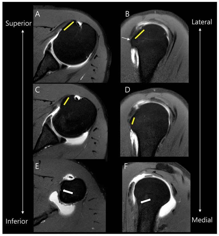 MRI panels mapping the superior and inferior facets of the subscapularis insertion on the lesser tuberosity