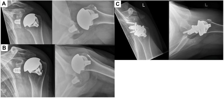 Serial radiographs showing anterior translation after subscapularis failure and revision from anatomic to reverse arthroplasty