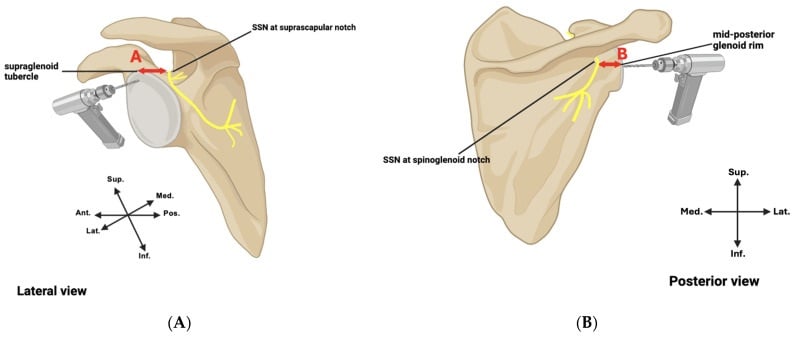 Scapular diagrams showing superior and posterior suprascapular nerve safe zones for reverse shoulder baseplate screws