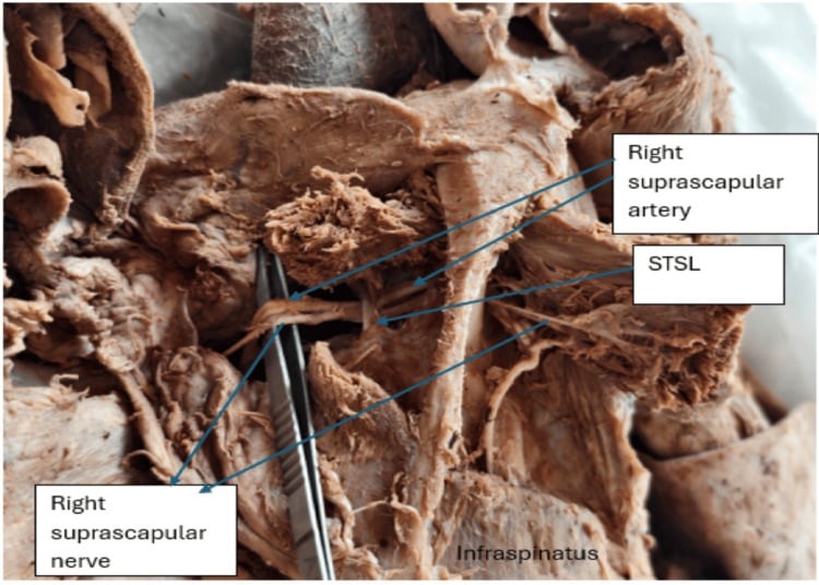 Posterior cadaveric dissection showing the suprascapular nerve and artery at the superior transverse scapular ligament