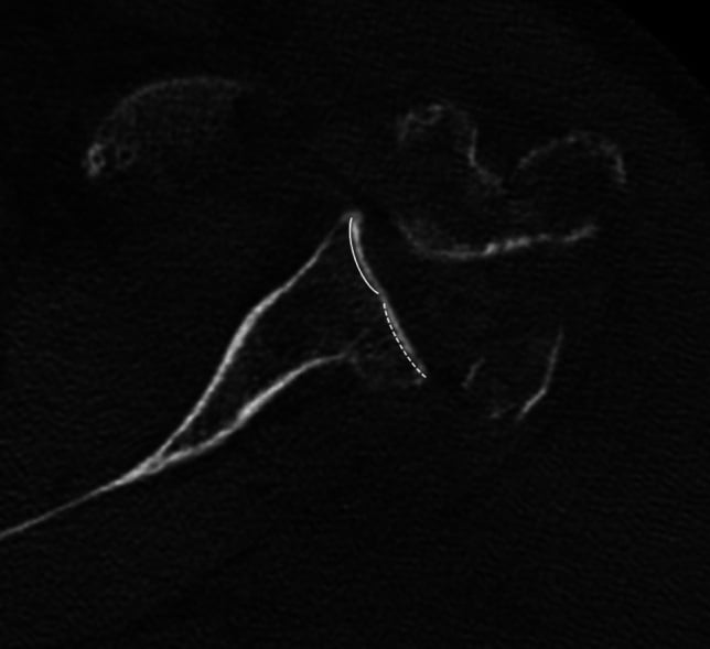 Axial CT showing a Walch B2 biconcave glenoid with paleoglenoid and posterior neoglenoid