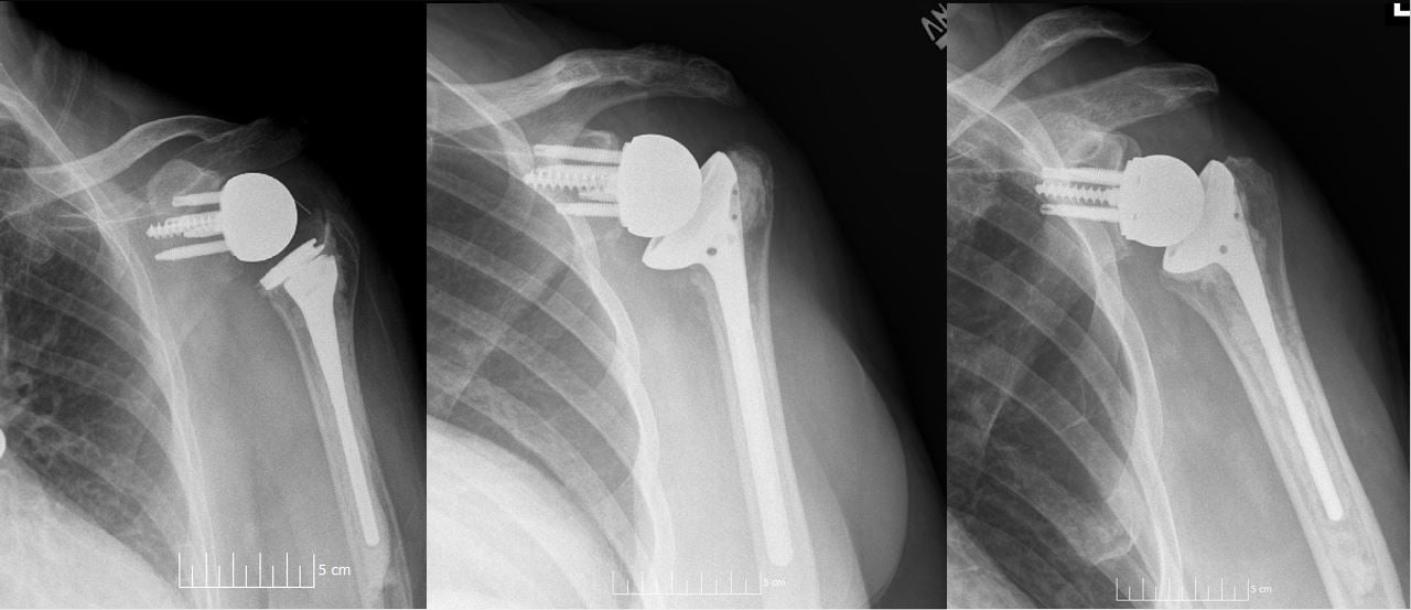 Three different reverse shoulder arthroplasty prosthesis designs on X-ray