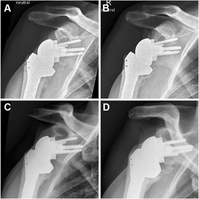 Serial AP radiographs showing progressive heterotopic ossification around a reverse shoulder arthroplasty