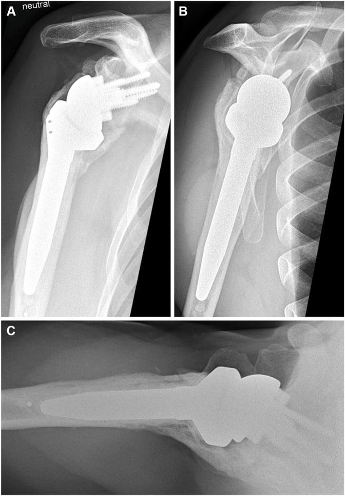 AP, Neer and axial radiographs showing glenohumeral ankylosis around a reverse shoulder arthroplasty
