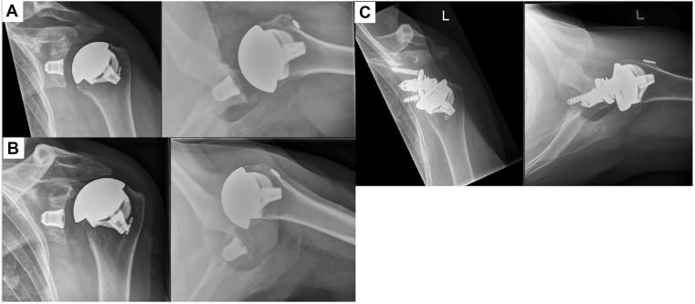 Serial radiographs showing anterior humeral translation after anatomic shoulder arthroplasty and later revision to reverse arthroplasty