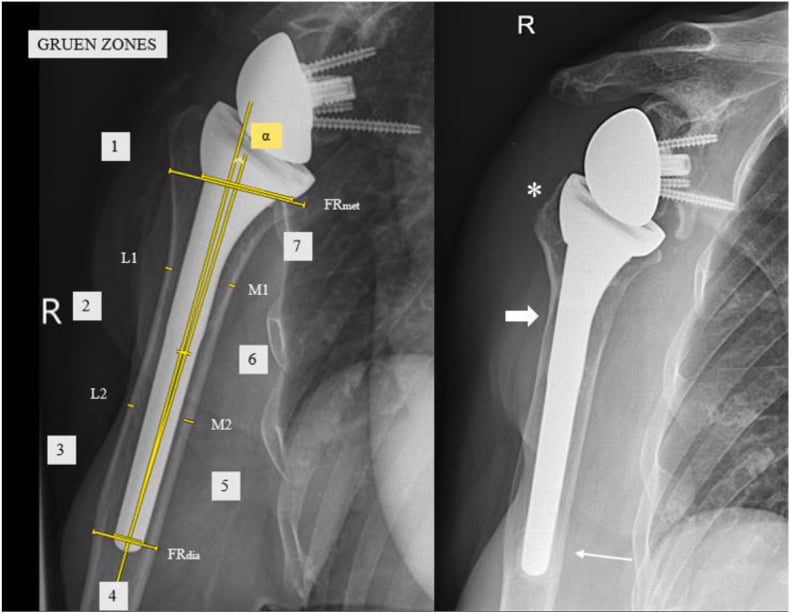 Shoulder arthroplasty radiographs showing Gruen zones and humeral stem alignment measurements