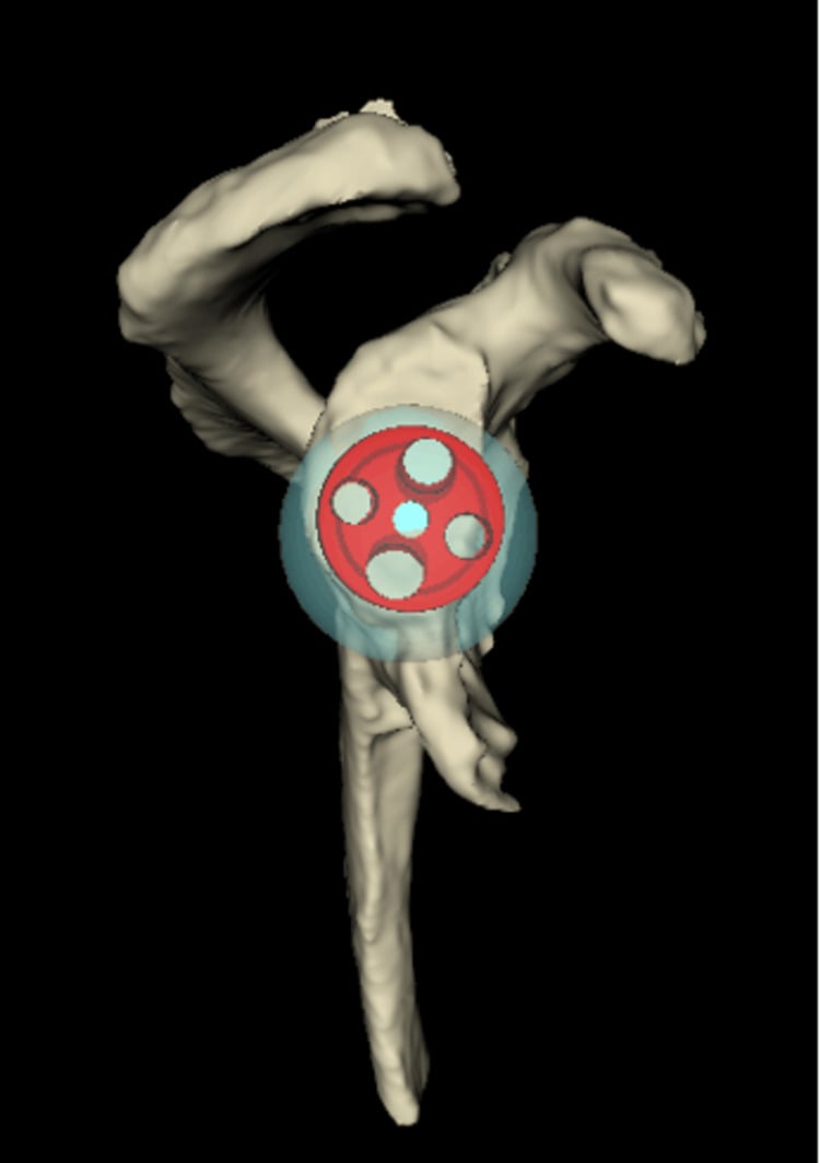 Three-dimensional CT planning view showing a reverse shoulder glenoid baseplate and screw trajectories