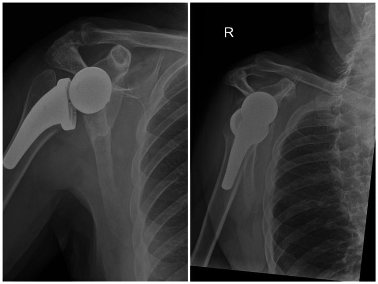 Four-year AP and oblique radiographs showing maintained reverse shoulder arthroplasty position