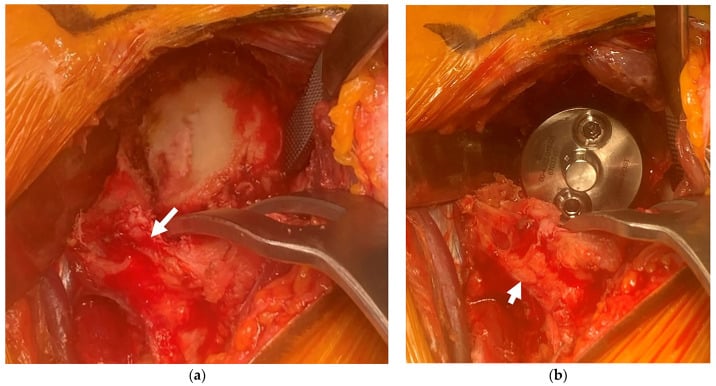 Intraoperative views showing glenoid exposure and reverse shoulder baseplate placement