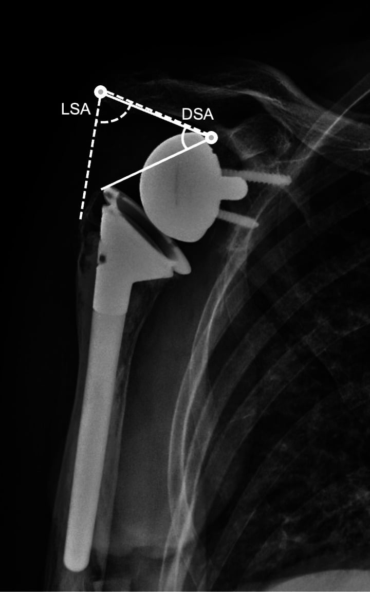 Reverse shoulder arthroplasty radiograph showing severe scapular notching with lateralisation and distalisation angles