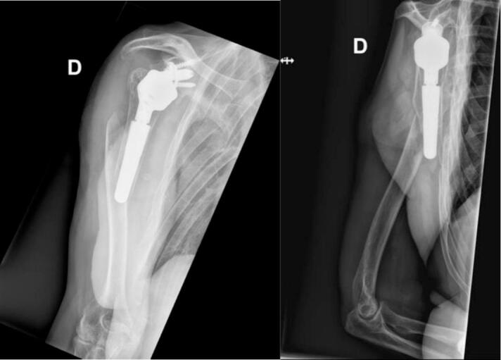AP and lateral radiographs showing a periprosthetic humeral shaft fracture around a shoulder arthroplasty stem