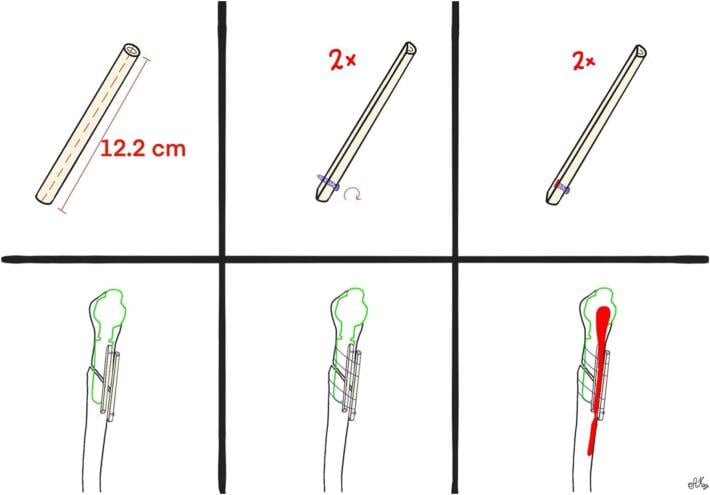 Schematic showing preparation and placement of split fibular strut allografts around a periprosthetic humeral fracture