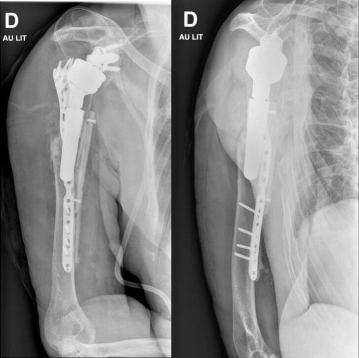 Postoperative AP and lateral radiographs after revision fixation of a periprosthetic humeral fracture