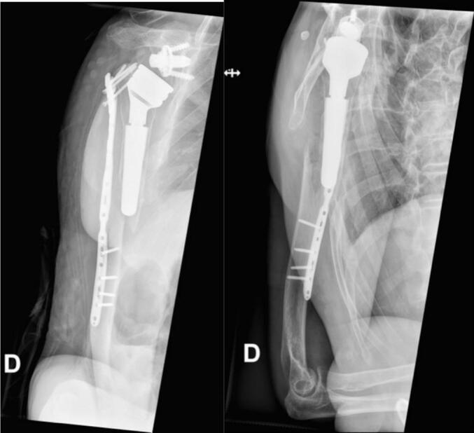 AP and lateral radiographs showing early loss of reduction after fixation of a periprosthetic humeral fracture