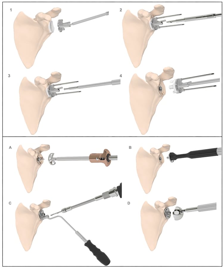 Schematic sequence for removing an anatomic shoulder glenoid baseplate and preparing a revision reverse shoulder baseplate