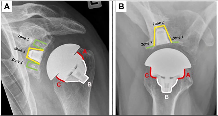AP and axillary shoulder radiographs with radiolucent zones around glenoid and humeral components labelled