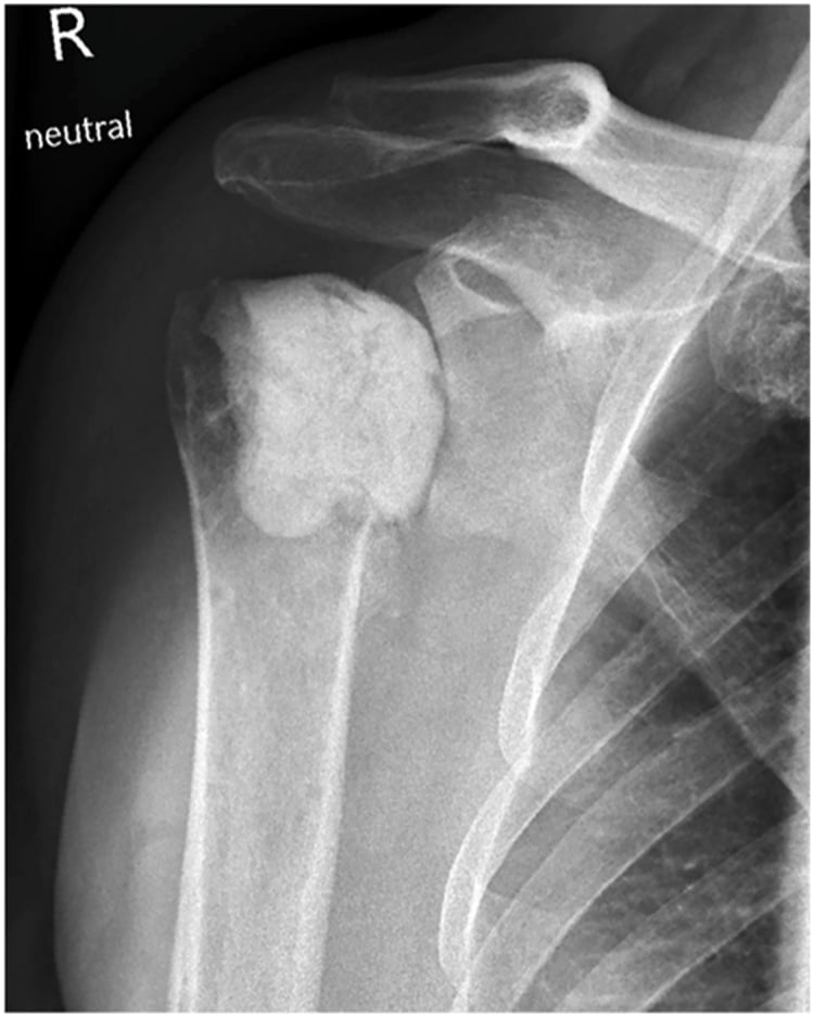 AP radiograph showing a shoulder antibiotic cement spacer after the first revision for infection