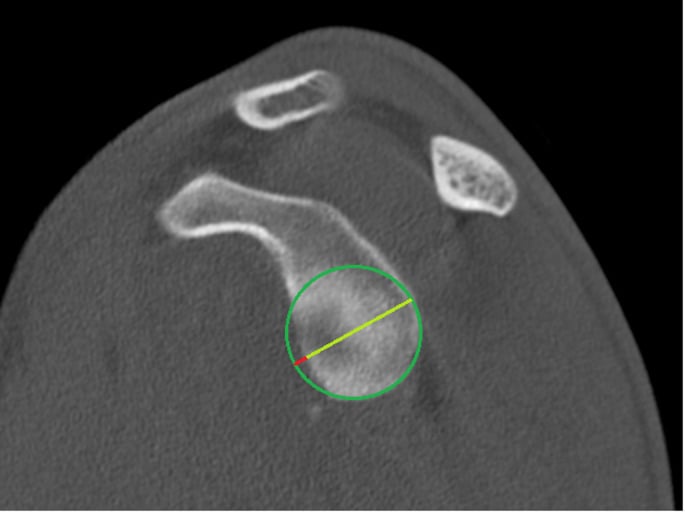 Axial CT scan measuring anterior glenoid bone loss percentage