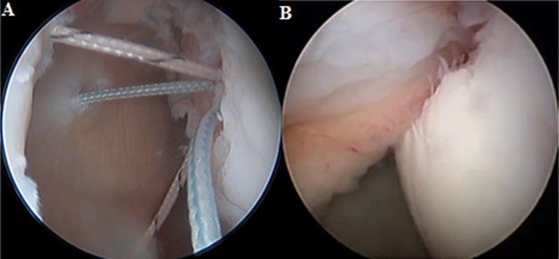 Arthroscopic views of remplissage capsulotenodesis into a Hill-Sachs defect