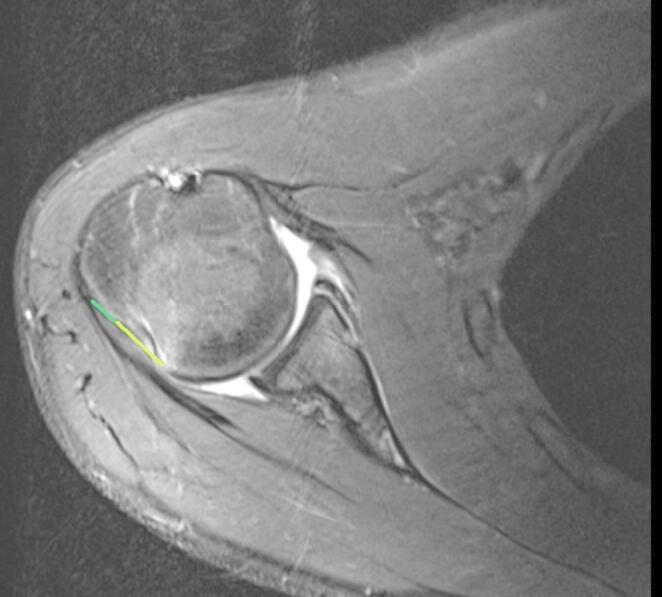 Axial T2 MRI showing anterior Bankart tear and posterolateral Hill-Sachs lesion