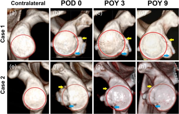 3D CT volume-rendered reconstruction evaluating glenoid bone loss and Latarjet graft positioning