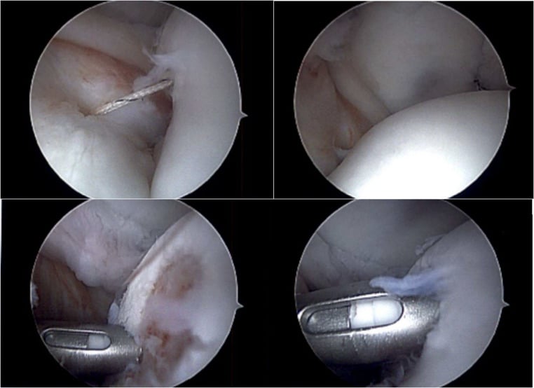 Arthroscopic views of Bankart labral repair using suture anchors