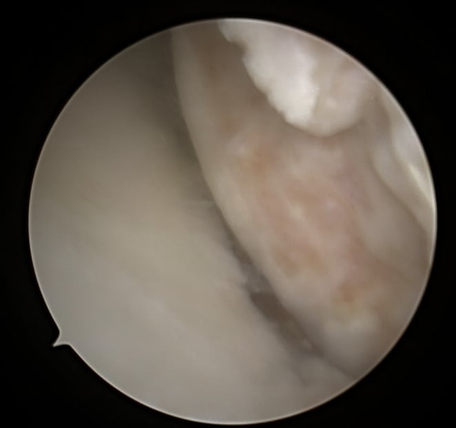 Arthroscopic view of an engaging off-track Hill-Sachs lesion