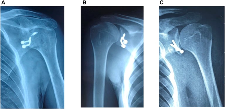 AP shoulder radiographs demonstrating Latarjet coracoid transfer with screw fixation