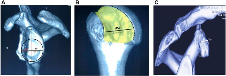 3D CT reconstructions demonstrating glenoid track and Hill-Sachs engagement