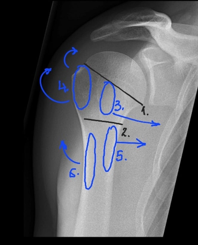 Annotated proximal humerus radiograph showing head neck and tuberosity segments with displacement forces