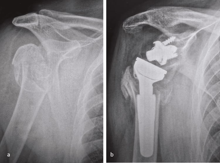 Preoperative comminuted proximal-humerus fracture and postoperative reverse shoulder arthroplasty