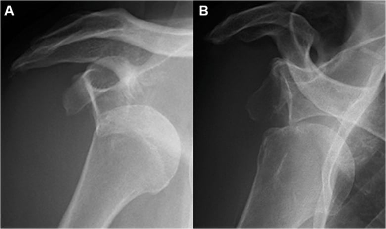 AP radiographs showing greater-tuberosity position during anterior shoulder dislocation