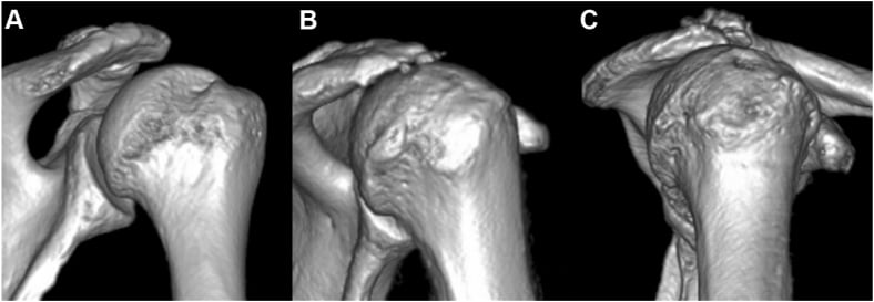 Three-dimensional CT showing different humeral-head impaction patterns after anterior dislocation
