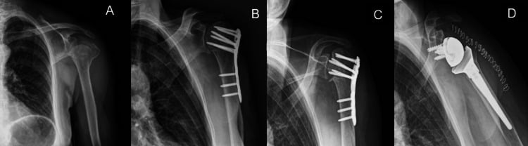 Serial radiographs A to D showing a fracture, plate fixation, collapse of the fixed head and conversion to reverse arthroplasty