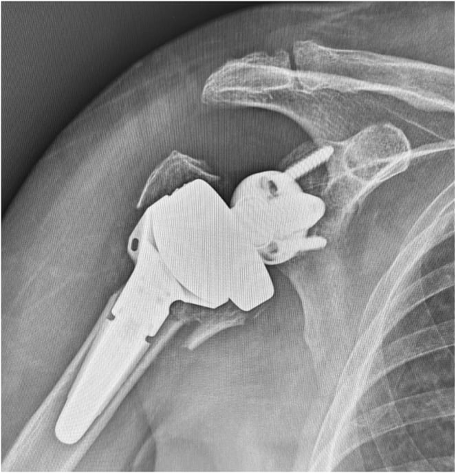 Radiograph showing migrated tuberosity nonunion after reverse shoulder arthroplasty