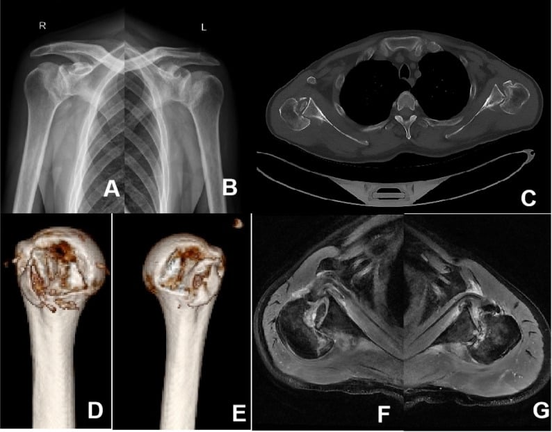 Bilateral posterior shoulder fracture-dislocations on AP radiographs, axial CT, three-dimensional reconstructions and axial MRI