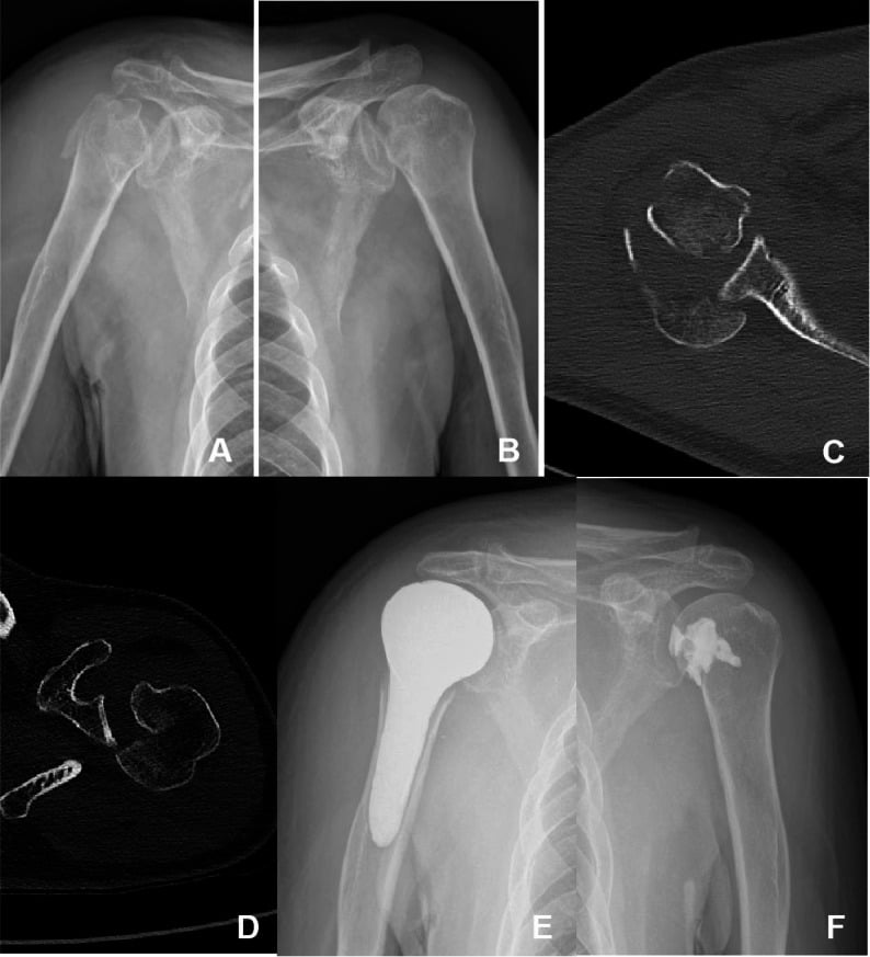 Bilateral posterior fracture-dislocations before treatment and after arthroplasty on one side and head-preserving reconstruction on the other