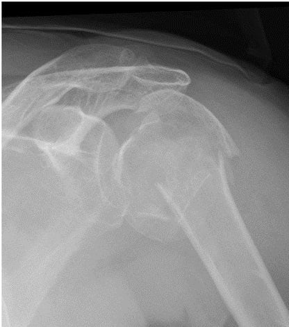 Complex proximal humerus fracture X-ray