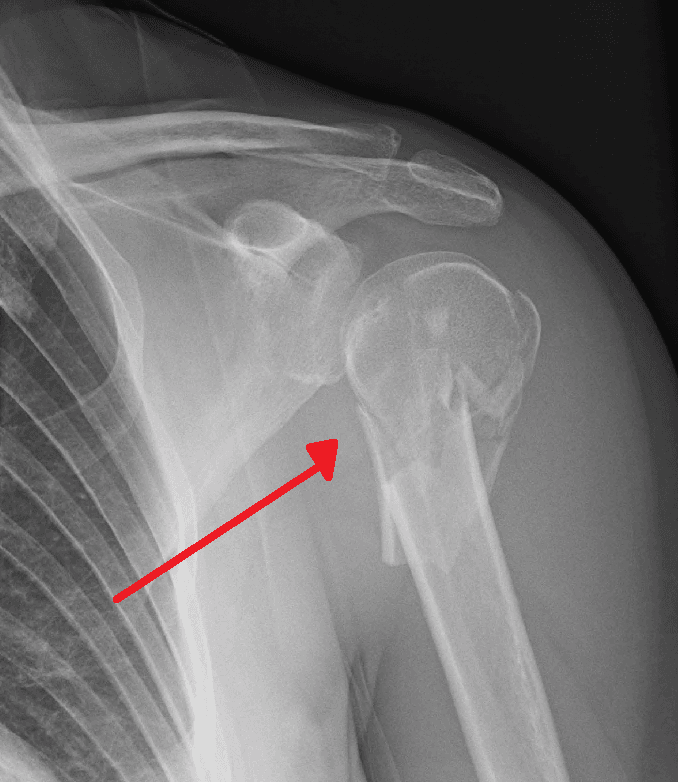 AP shoulder radiograph of a displaced proximal humerus fracture at the surgical neck (arrow)