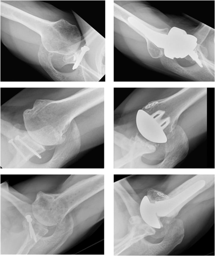 Preoperative and postoperative axial radiographs after reverse, anatomic and hemiarthroplasty procedures showing subluxation assessment