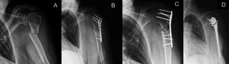Radiograph series of a two-part fracture, plate fixation, nonunion at nine months and conversion to reverse arthroplasty