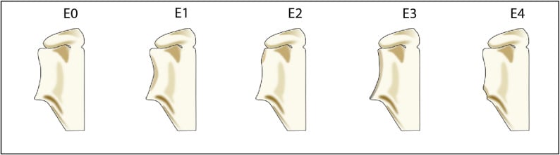 Diagram of the Favard classification of glenoid erosion grades E0 to E4
