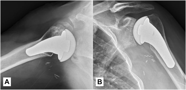 One-year axillary and Grashey radiographs showing a well-centred humeral head with glenoid remodelling and maintained congruency