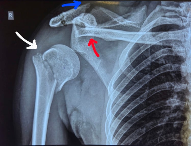 Radiograph of a displaced two-part proximal humeral fracture with anterior-inferior head dislocation and associated injuries