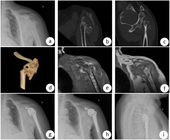 Radiograph, CT, three-dimensional reconstruction, MRI and postoperative films of a comminuted proximal humeral fracture