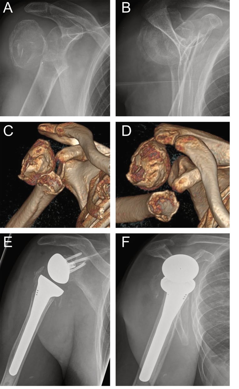 AP and Y-view radiographs of a head-split fracture-dislocation with three-dimensional reconstruction and postoperative arthroplasty films