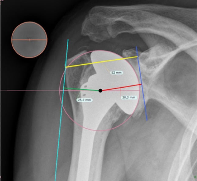 Radiograph annotated with the calibration ball, centre of rotation and reference lines used to measure humeral offset after arthroplasty