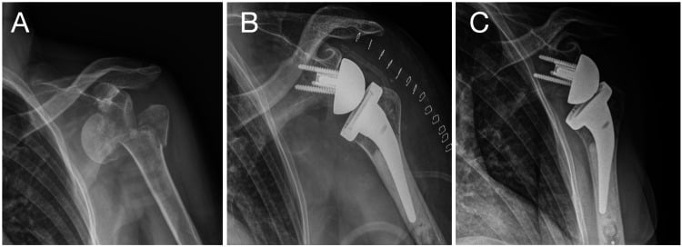 Radiographs of a three-part fracture with anterior dislocation, primary cemented arthroplasty and complete tuberosity healing at two years