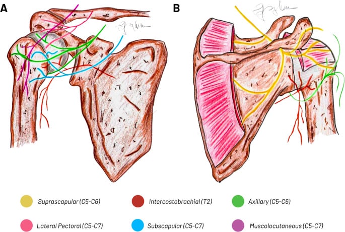 Schematic of the sensory innervation of the shoulder and proximal humerus showing axillary, suprascapular, lateral pectoral, subscapular, intercostobrachial and musculocutaneous contributions