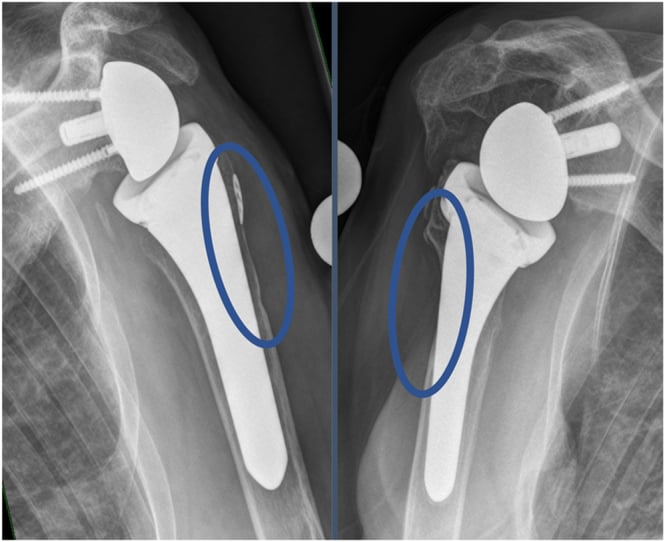 Radiographs illustrating low-grade partial cortical thinning and high-grade full cortical thinning around a humeral stem
